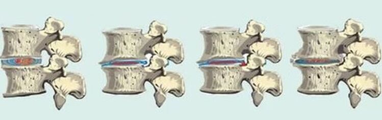 лезија на 'рбетот во случај на торакална остеохондроза