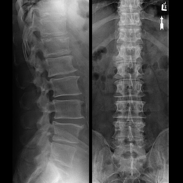 Рентген на торакалниот регион, што покажува намалување на јазот помеѓу пршлените долж 'рбетот од дното кон врвот