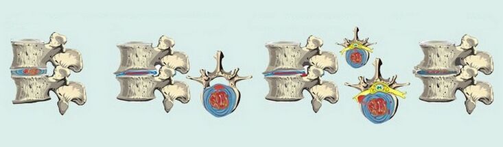 Фази на формирање на остеохондроза на 'рбетот