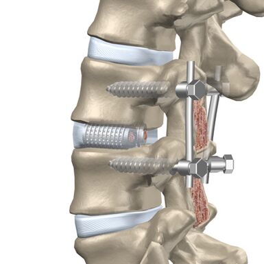 Замена на уништен диск на торакалниот 'рбет со вештачки имплант