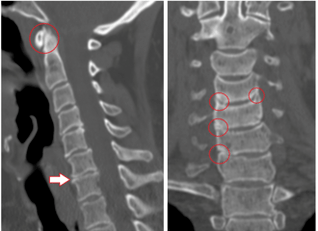 КТ скенот покажува оштетени пршлени и дискови со хетерогена висина поради торакална остеохондроза