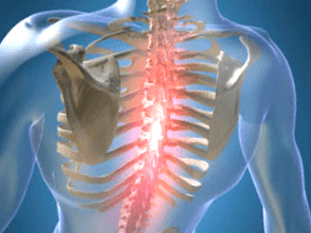 Рекурентна или постојана болна болка при остеохондроза на градниот кош